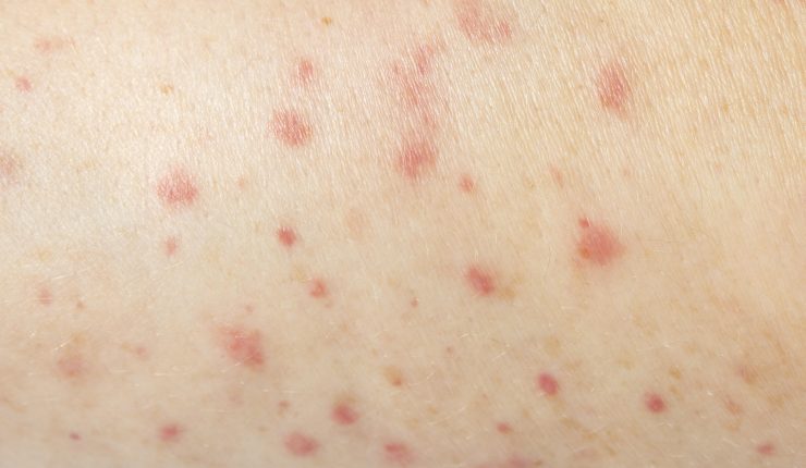 Cómo identificar los síntomas del sarampión y qué hacer si los presenta